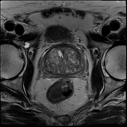 Prostate Lesions MRI