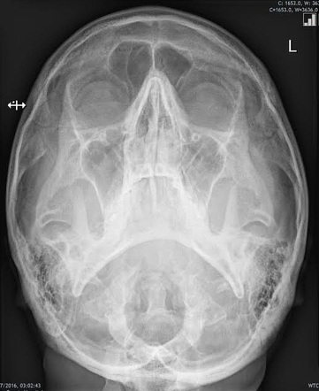 Normal facial radiograph - OM 30 | Radiology Case | Radiopaedia.org