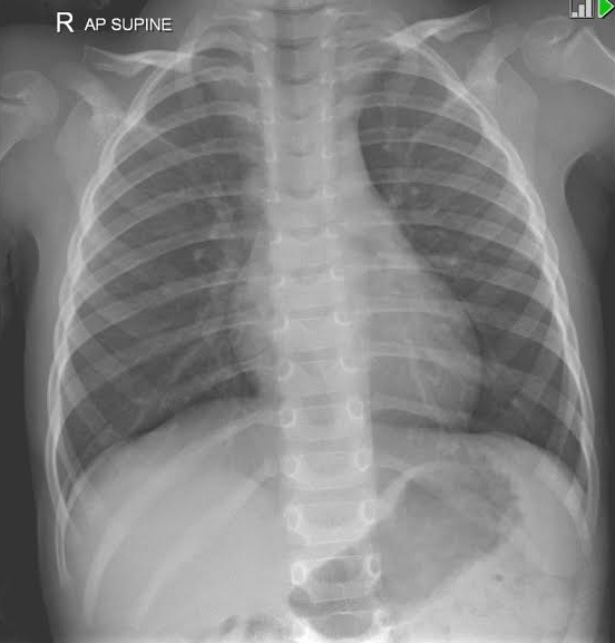 Normal Chest Radiograph Pediatric Radiology Case Radiopaedia Org