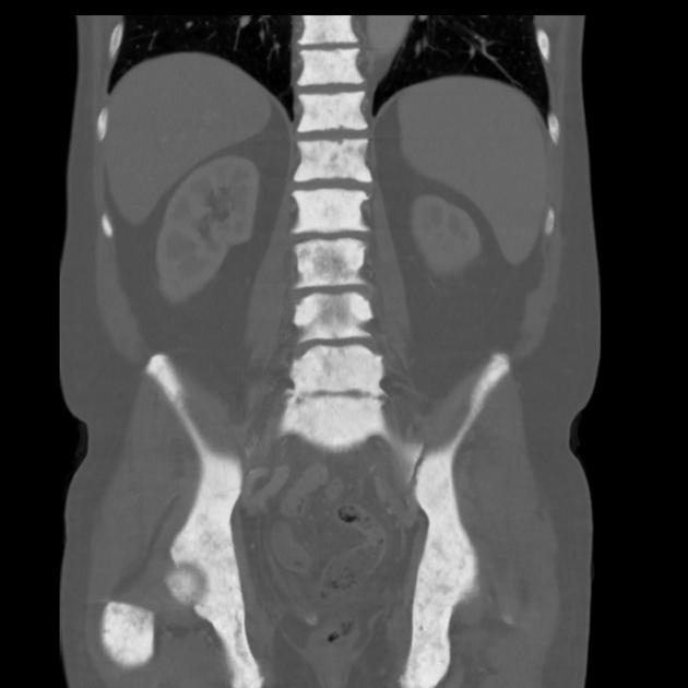 Skeletal Eburnation And Bone Superscan In Metastatic Prostate Cancer Radiology Case Radiopaedia Org