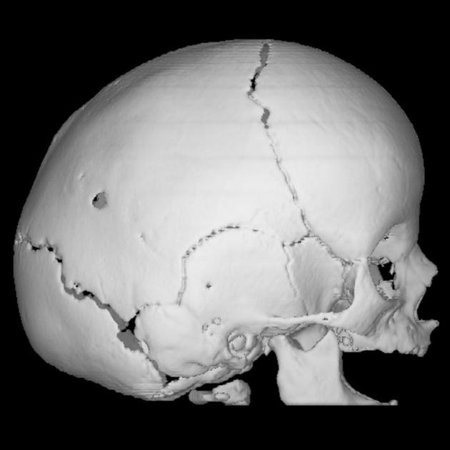 Scaphocephaly | Radiology Reference Article | Radiopaedia.org