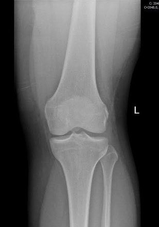 Normal AP knee radiograph | Radiology Case | Radiopaedia.org