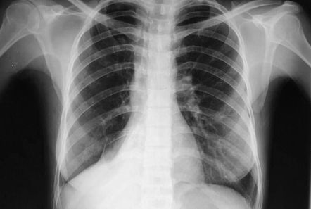 Right lower lobe collapse | Radiology Case | Radiopaedia.org