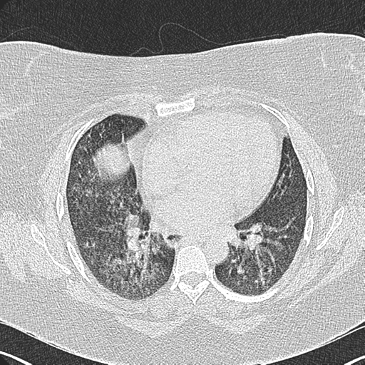 Infectious Bronchiolitis Image Radiopaedia Org