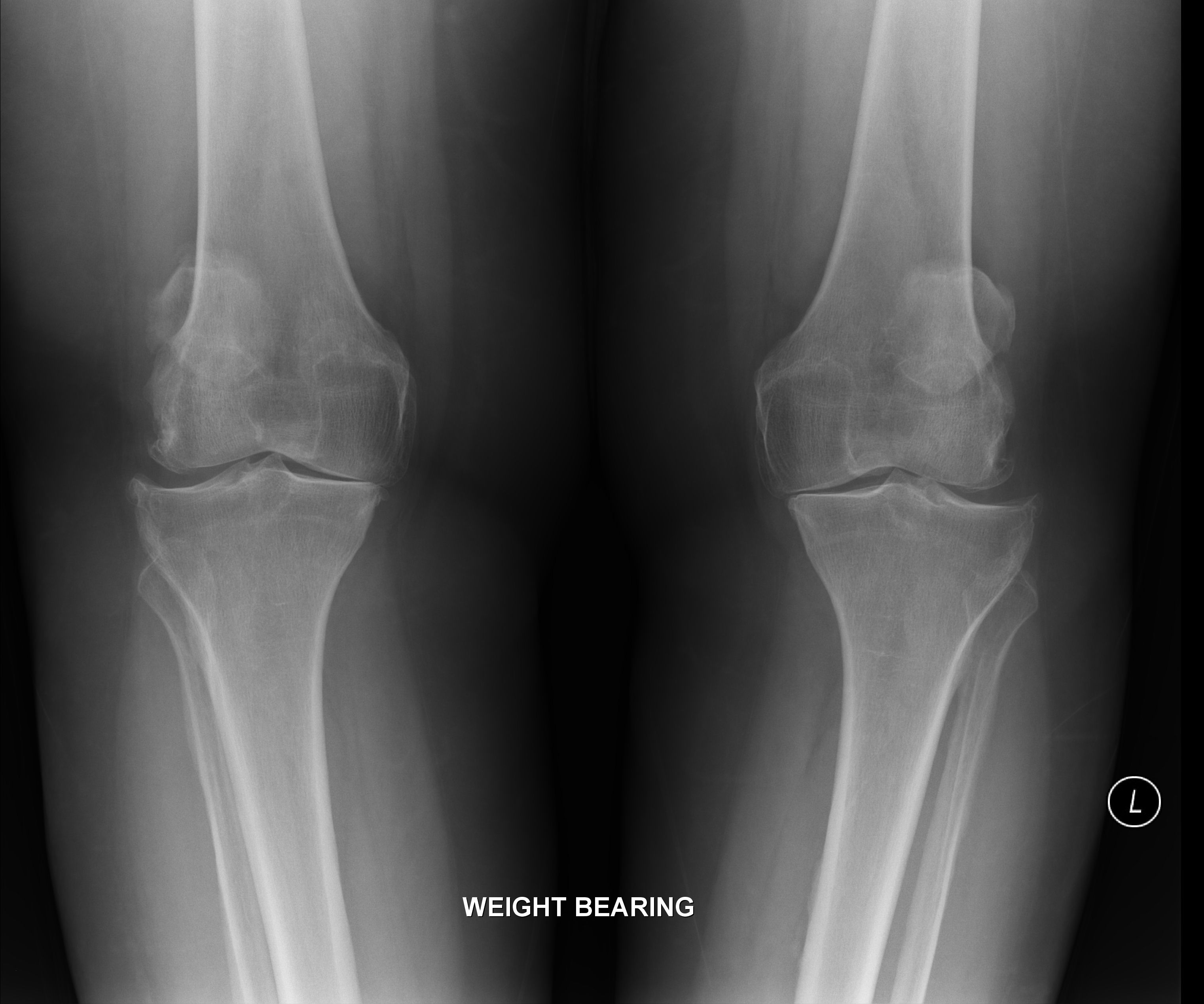 Modality: X-ray (Frontal) .