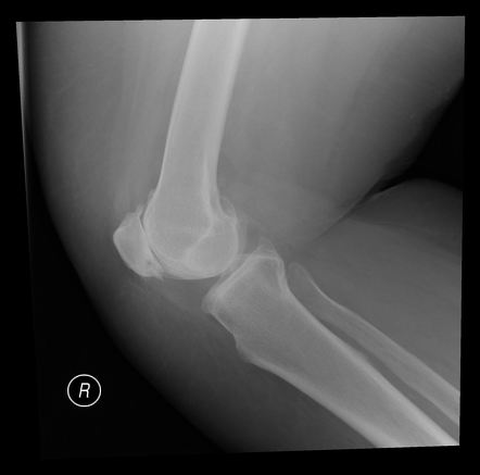 Osteoarthritis of knee | Image | Radiopaedia.org