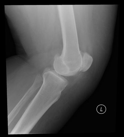 Osteoarthritis of knee | Image | Radiopaedia.org