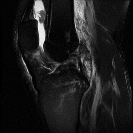 Medial And Lateral Meniscal Tears In A Complex Knee Injury 