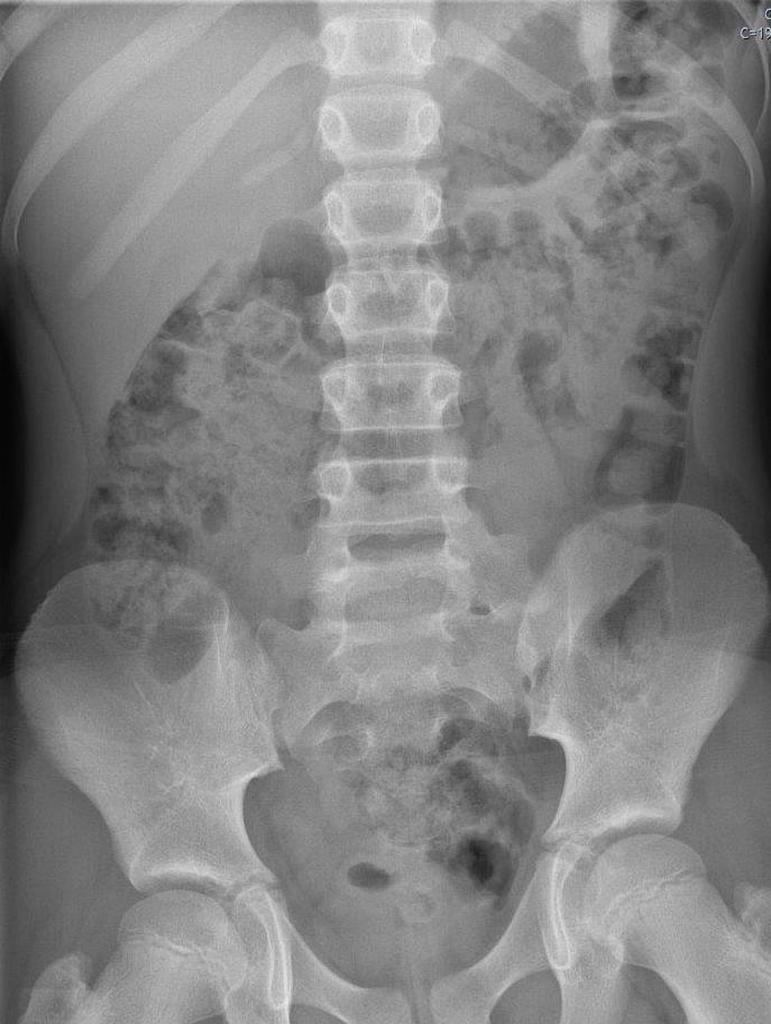 Normal Abdominal Radiograph Pediatric Radiology Case Radiopaedia Org