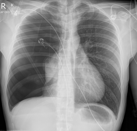 Spontaneous pneumothorax | Radiology Case | Radiopaedia.org