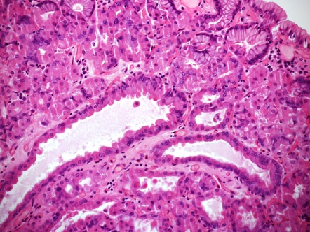 Fundic gland polyp (histology) | Image | Radiopaedia.org