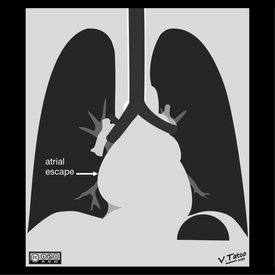 Chest Radiograph Wikipedia 0070