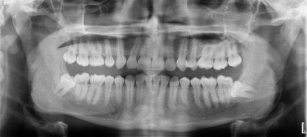 Normal OPG radiograph | Radiology Case | Radiopaedia.org