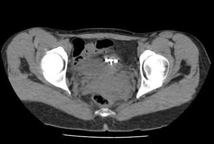 IUCD related uterine perforation | Image | Radiopaedia.org