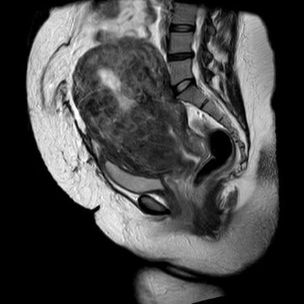 Diffuse uterine leiomyomatosis | Radiology Reference Article