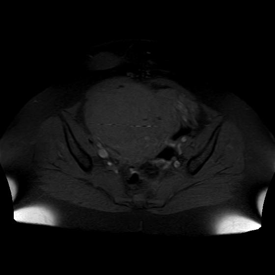 Diffuse Uterine Leiomyomatosis Image