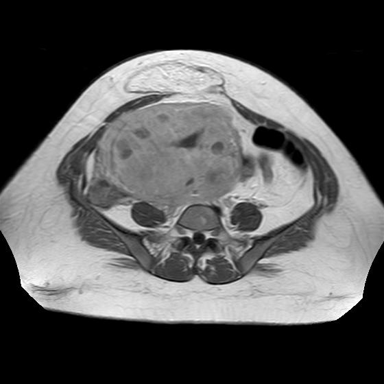 Diffuse Uterine Leiomyomatosis | Image | Radiopaedia.org