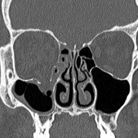 Orbital blowout fracture | Radiology Reference Article | Radiopaedia.org