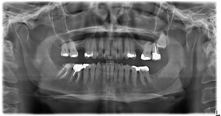 External dental root resorption | Radiology Case | Radiopaedia.org