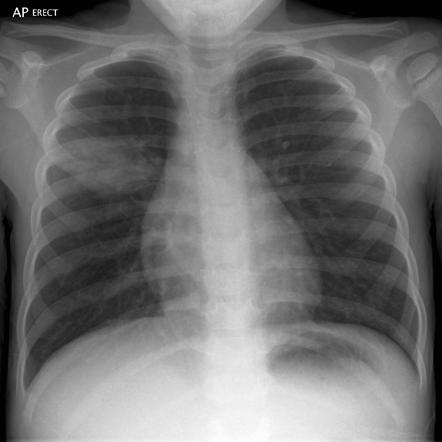 Round pneumonia | Radiology Reference Article | Radiopaedia.org