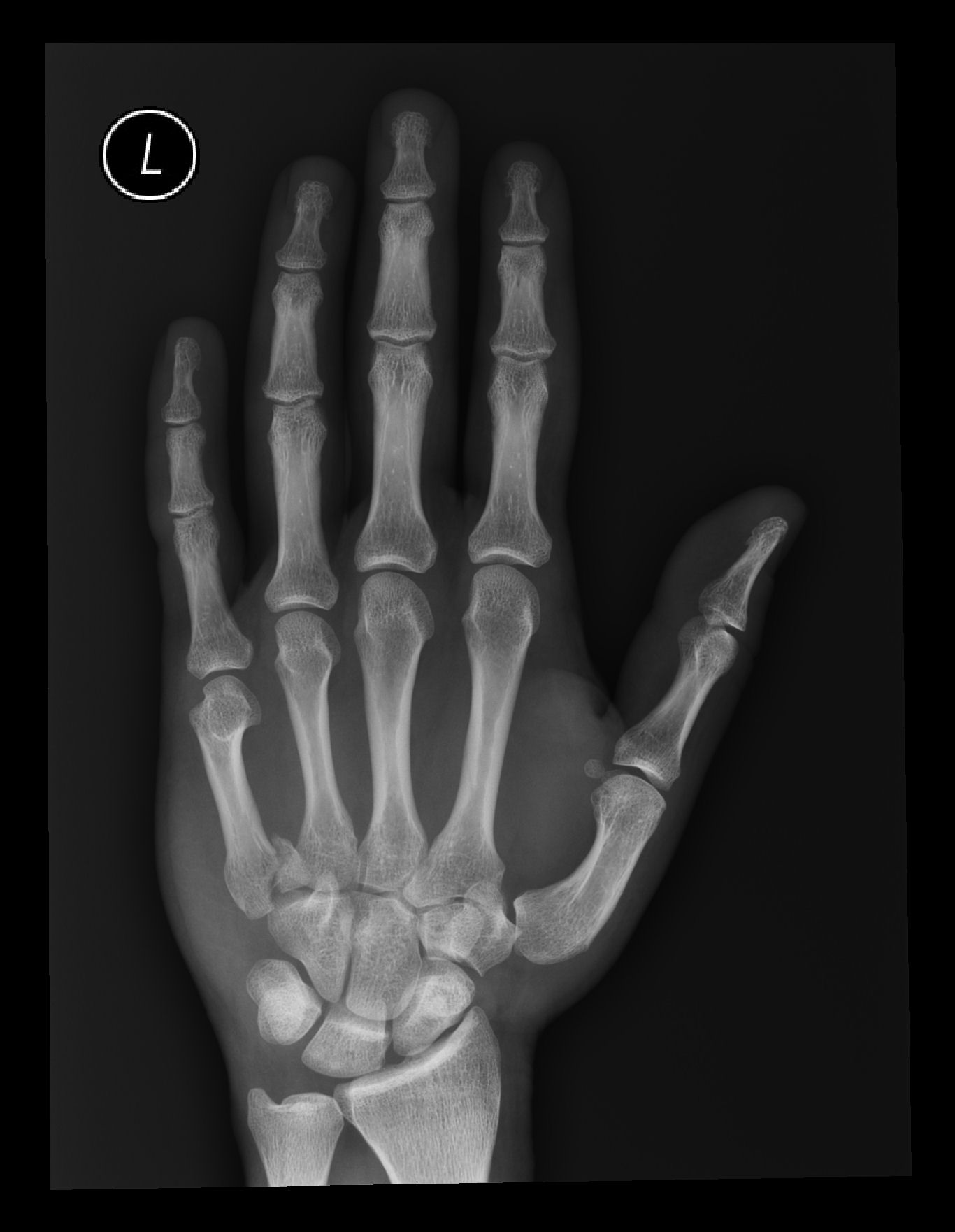 Reverse fracture dislocation Image