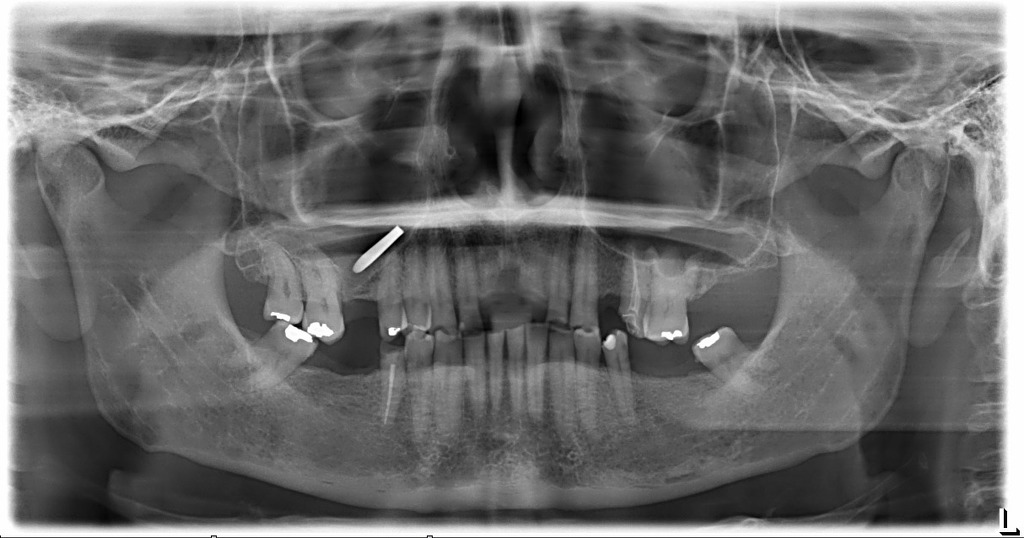 mucosal-thickening-of-maxillary-sinus-doctorvisit