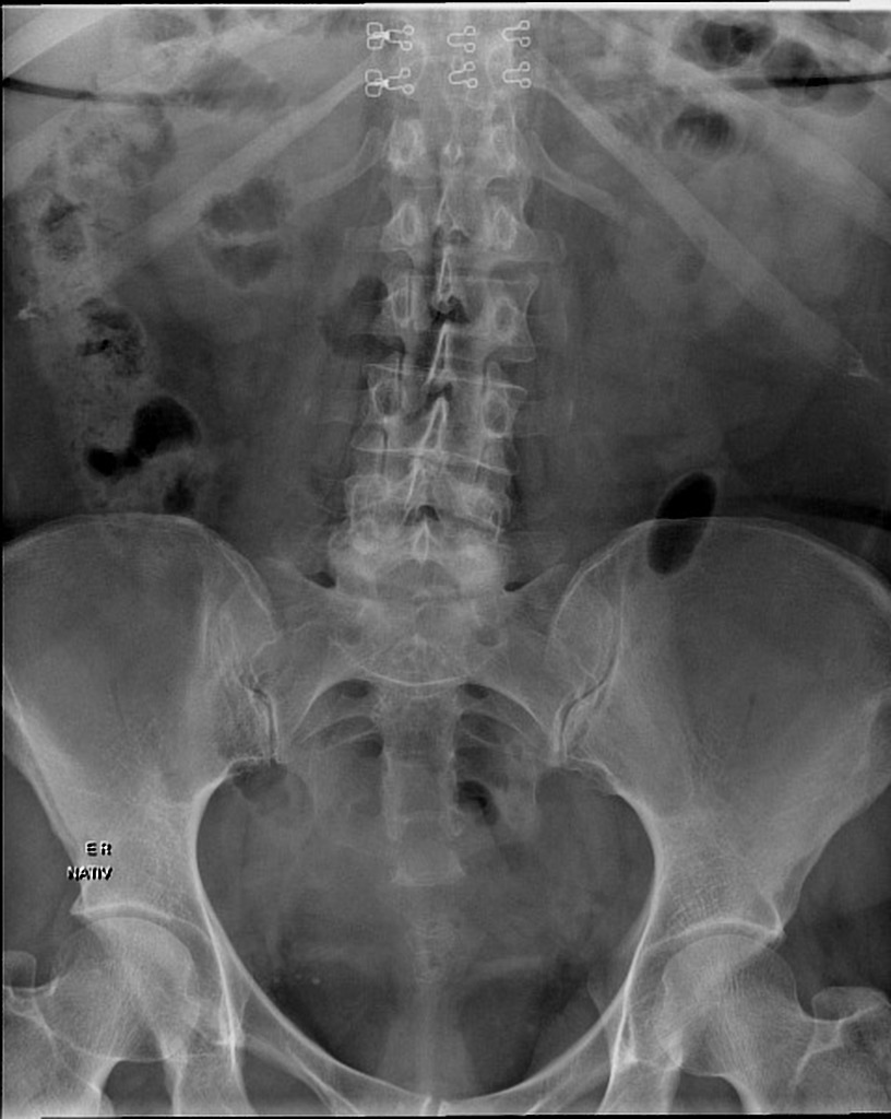 ureterocele ivp