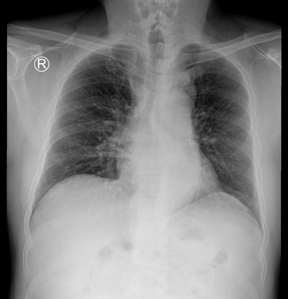 Left Vocal Cord Paralysis Secondary To Pseudocoarctation Of The Aorta Radiology Case Radiopaedia Org