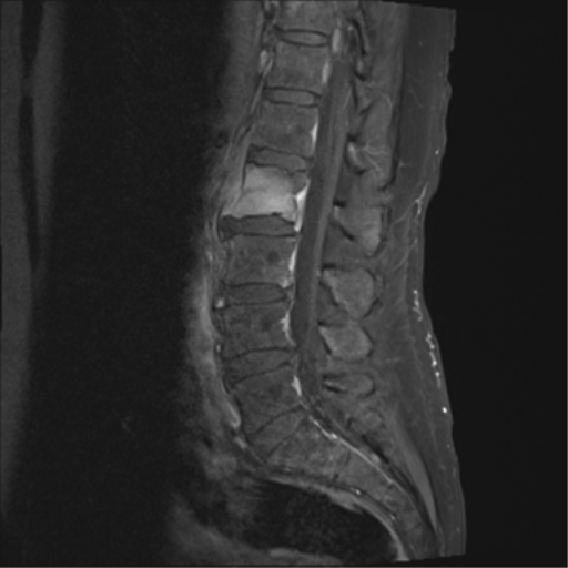 Discitis Osteomyelitis Eikenella Corrodens Image