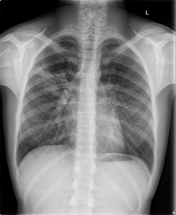 Right upper lobe pneumonia | Radiology Case | Radiopaedia.org