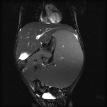 Gaucher disease | Radiology Reference Article | Radiopaedia.org