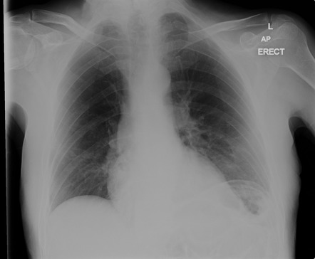 Pseudopneumoperitoneum | Radiology Case | Radiopaedia.org