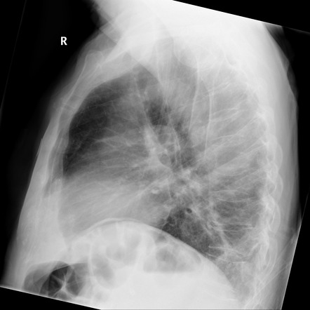 Pseudopneumoperitoneum | Image | Radiopaedia.org