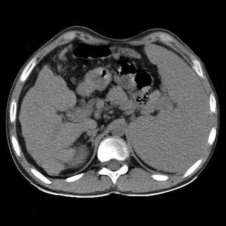 wilsons disease liver