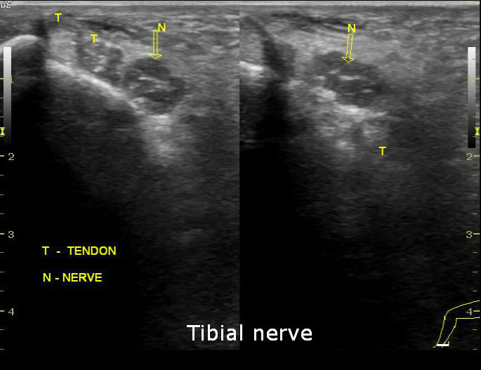 Peripheral nerve thickening - leprosy | Image | Radiopaedia.org