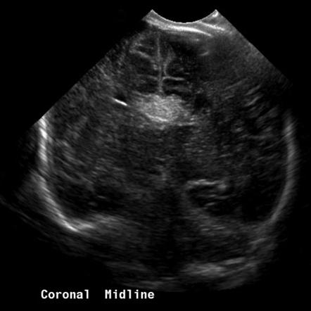 Pericallosal lipoma | Radiology Reference Article | Radiopaedia.org