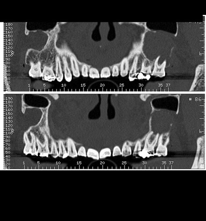 Cone Beam CT | Radiology Reference Article | Radiopaedia.org