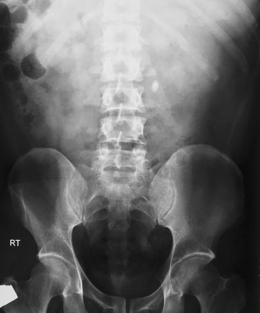 Ureteric stone | Radiology Case | Radiopaedia.org