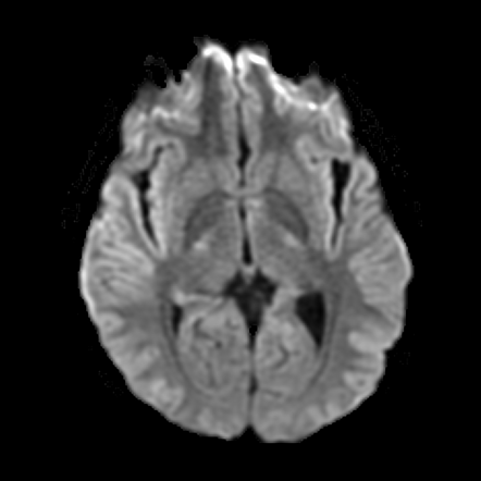 Neuromyelitis optica spectrum disorder | Image | Radiopaedia.org