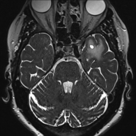 Anterior temporal lobe perivascular spaces | Radiology Reference ...