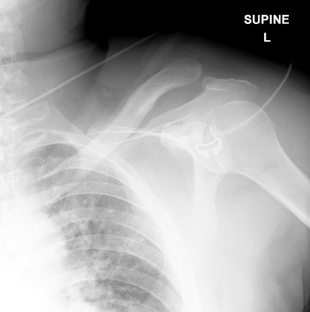 Acromioclavicular Joint Injury 