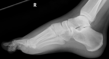 Lisfranc Injury 