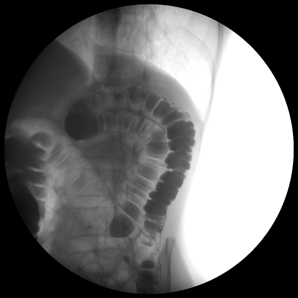 Redundant colon on double contrast barium enema | Image | Radiopaedia.org