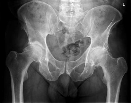 Femoroacetabular impingement - cam lesion | Image | Radiopaedia.org