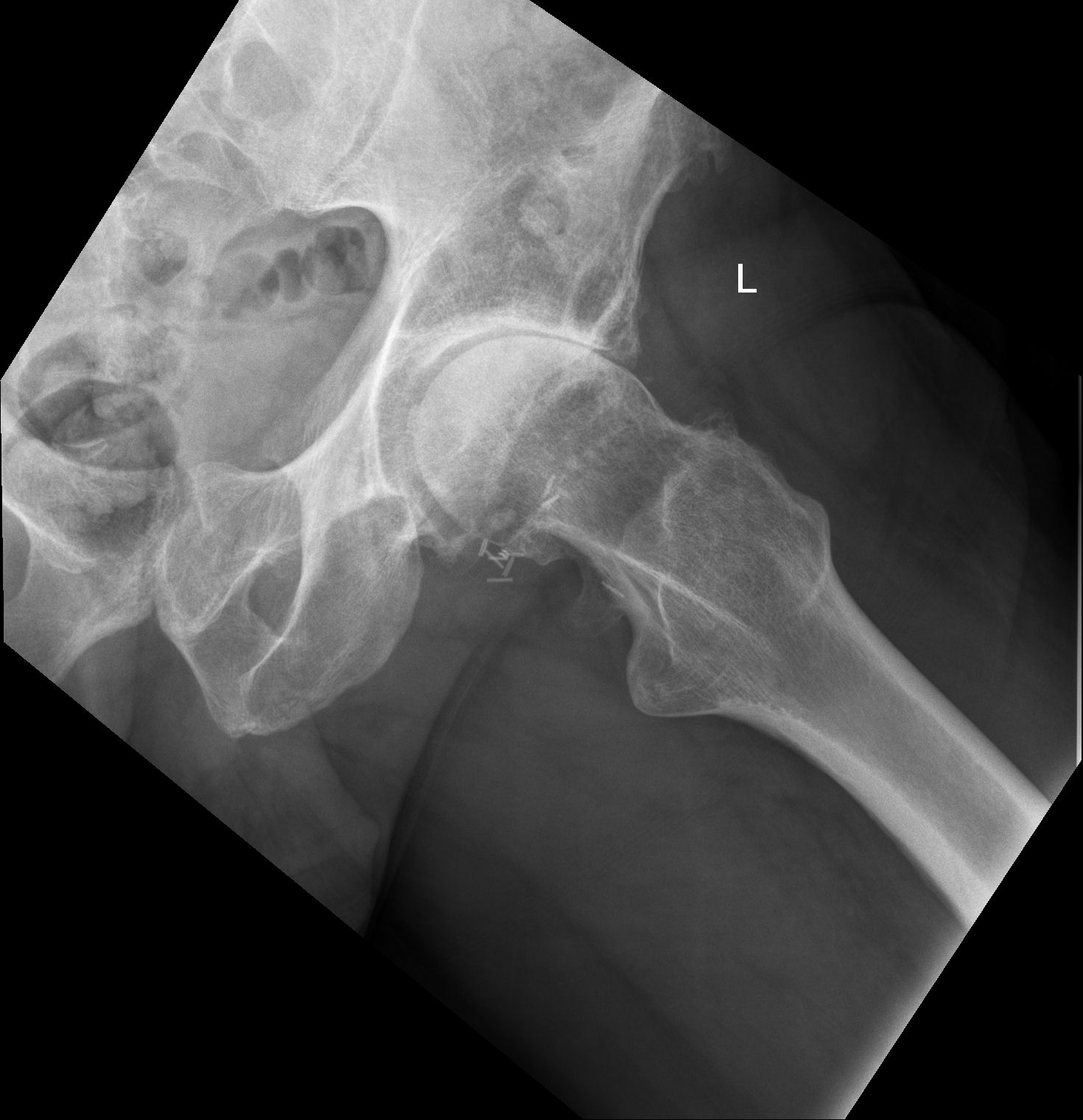 Femoroacetabular impingement cam lesion Image