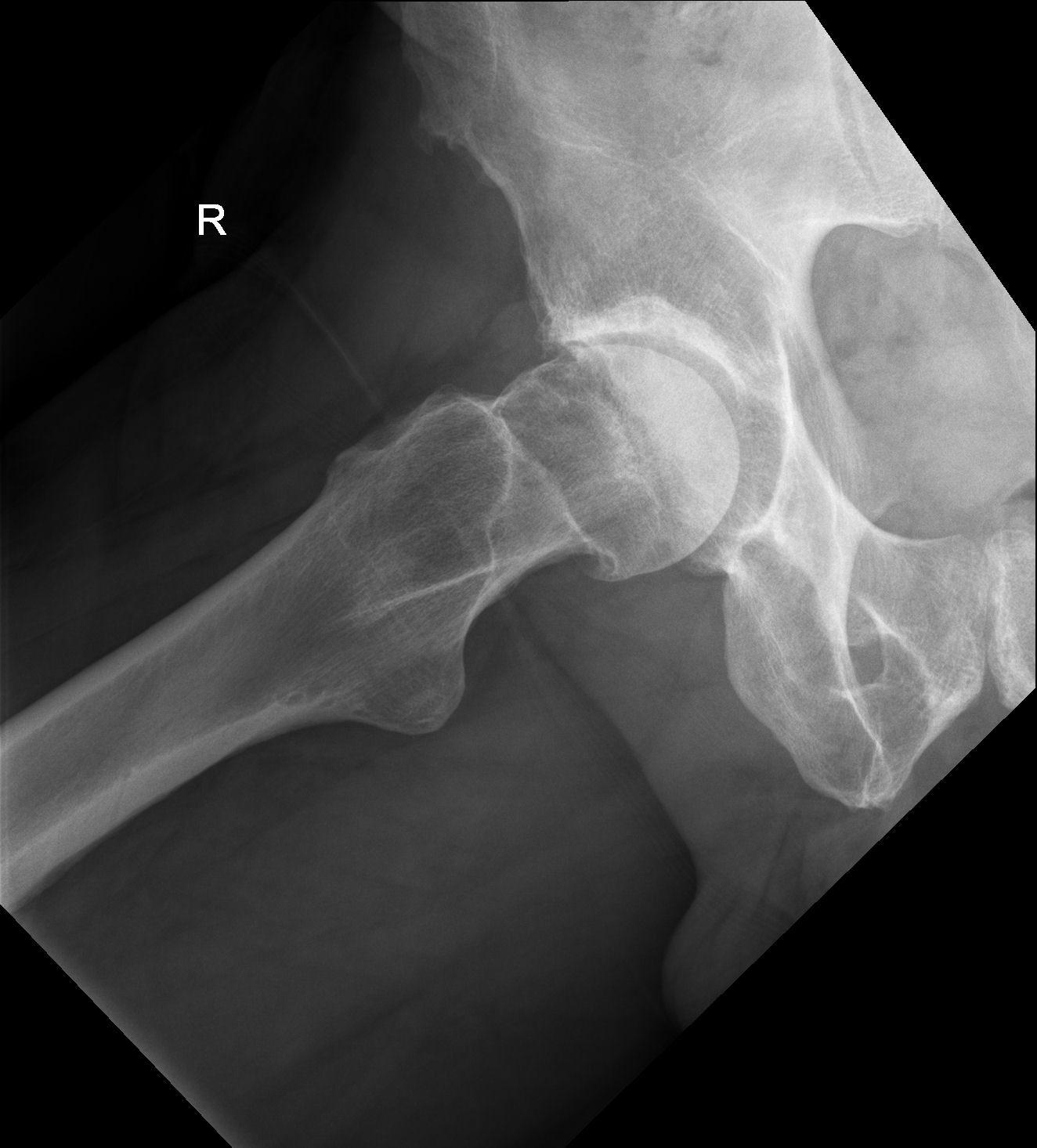 Femoroacetabular impingement - cam lesion | Image | Radiopaedia.org