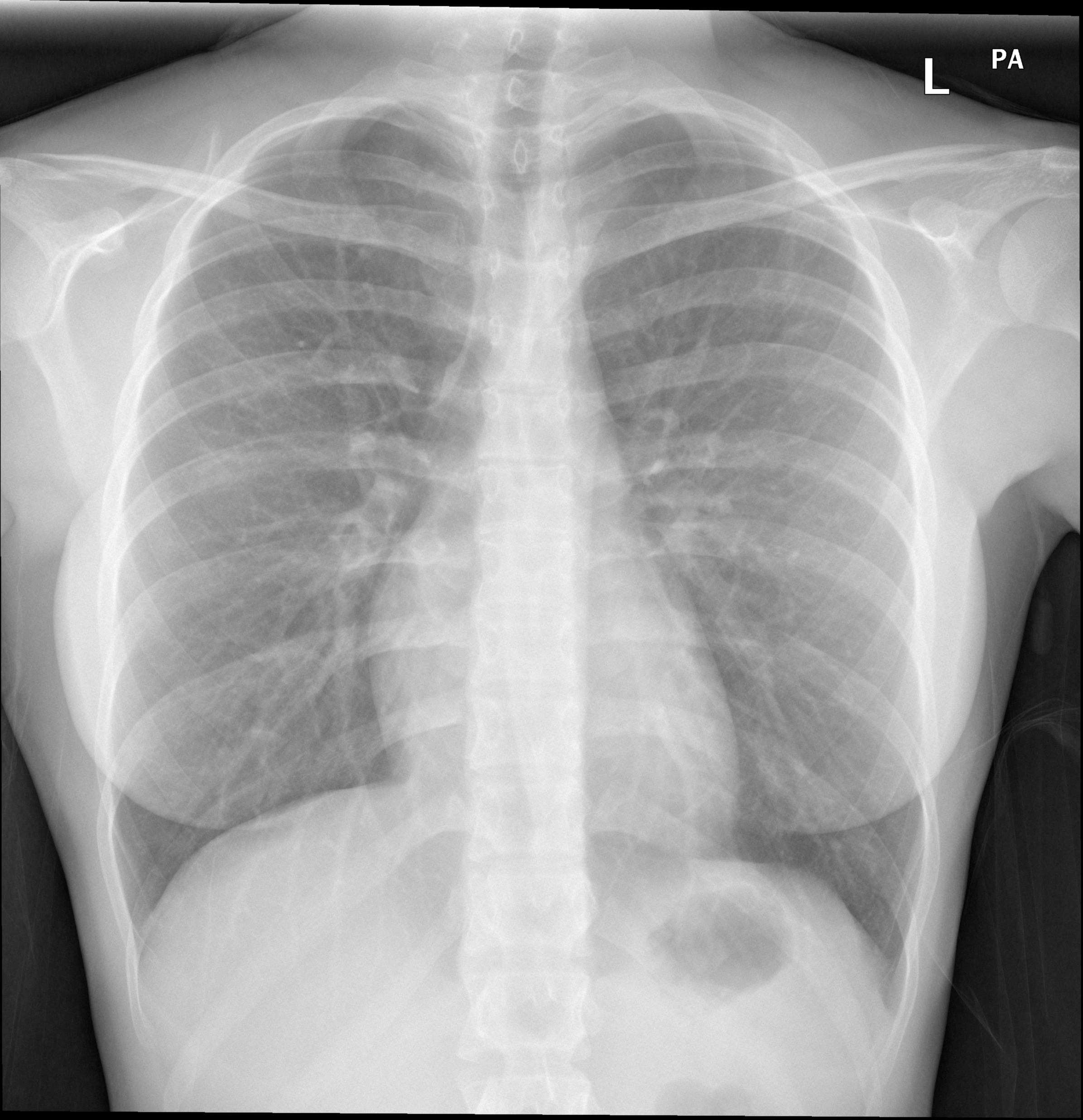 Normal CTPA | Image | Radiopaedia.org