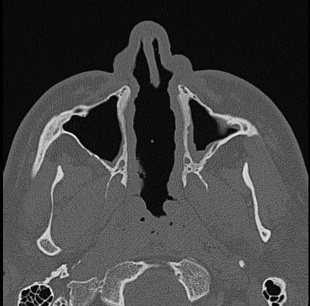 Nasal Septal Perforation Radiology Reference Article Radiopaedia Org