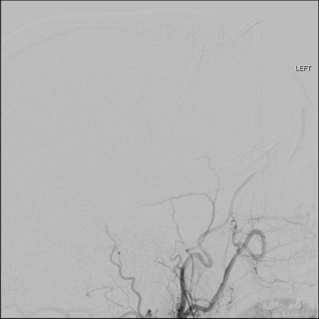 Subarachnoid hemorrhage | Image | Radiopaedia.org