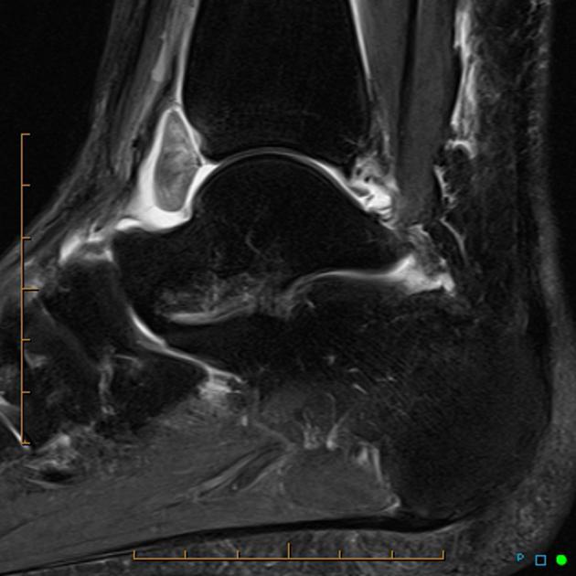 MRI Of Ankle Sprain: The Association Between Joint Effusion, 41% OFF